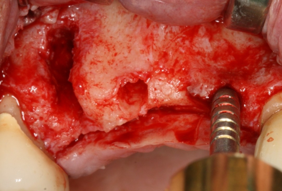 botiss cerabone® & Jason® membrane for GBR - Clinical case by Prof. Dr. Dr. D. Rothamel