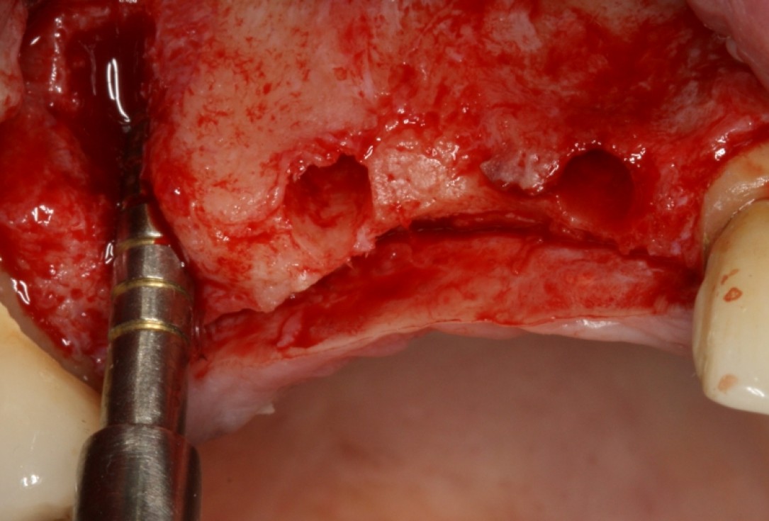 botiss cerabone® & Jason® membrane for GBR - Clinical case by Prof. Dr. Dr. D. Rothamel