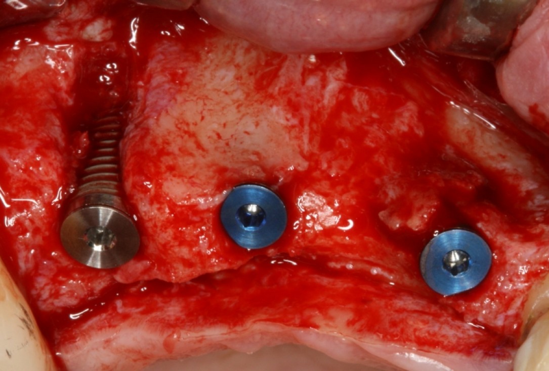botiss cerabone® & Jason® membrane for GBR - Clinical case by Prof. Dr. Dr. D. Rothamel