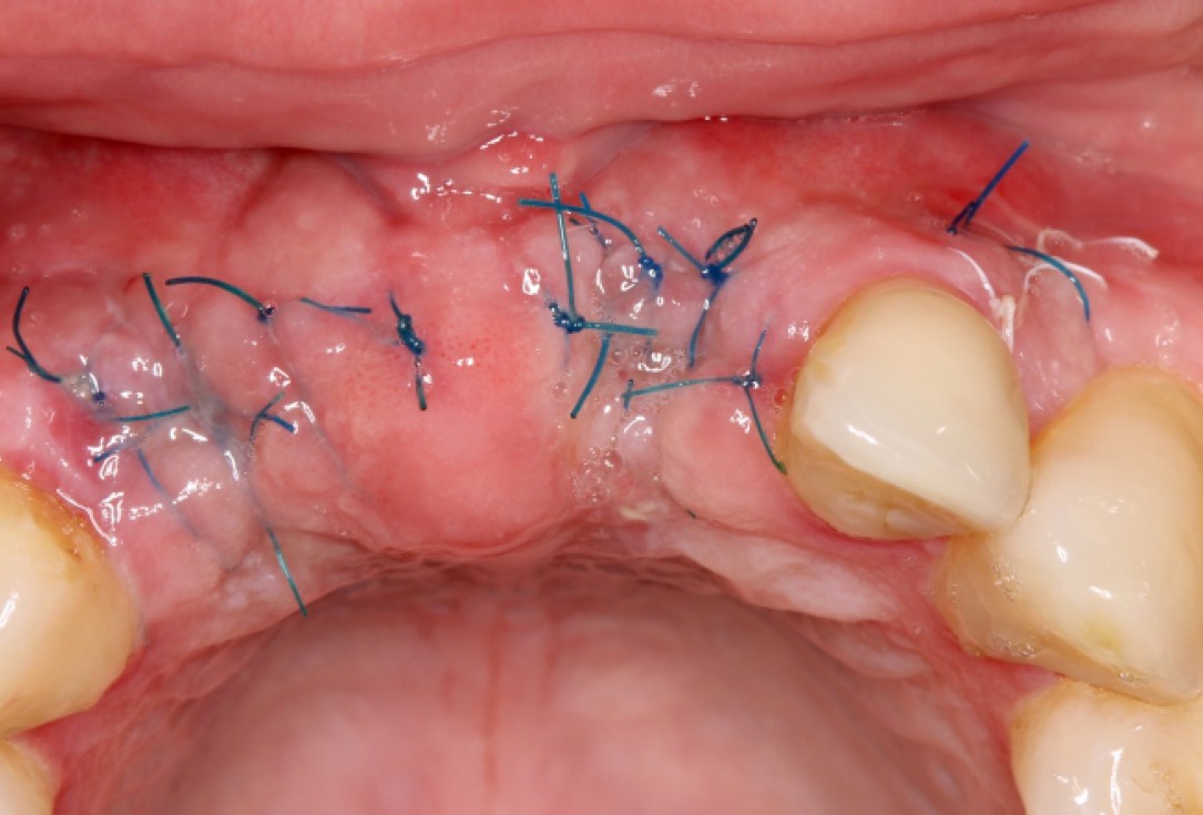 botiss cerabone® & Jason® membrane for GBR - clinical case by Dr. S. Stavar