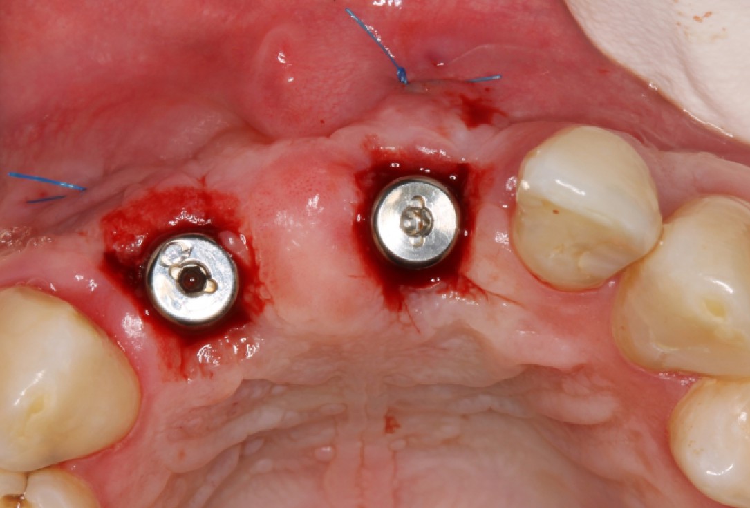 botiss cerabone® & Jason® membrane for GBR - clinical case by Dr. S. Stavar