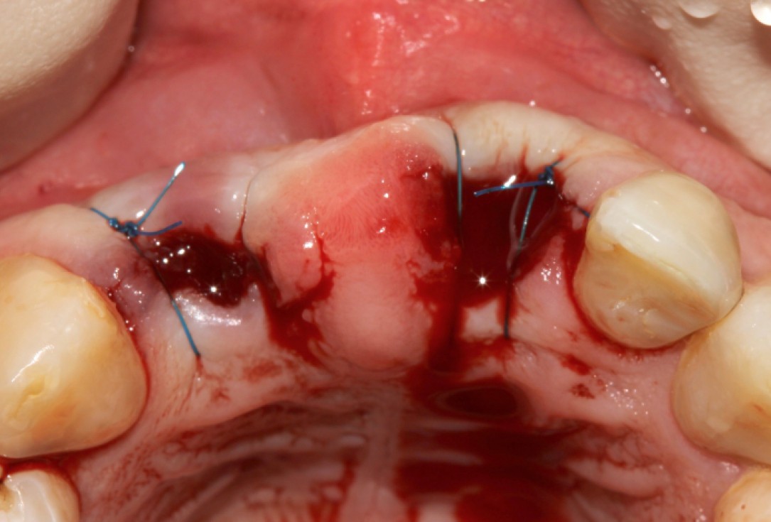 botiss cerabone® & Jason® membrane for GBR - clinical case by Dr. S. Stavar