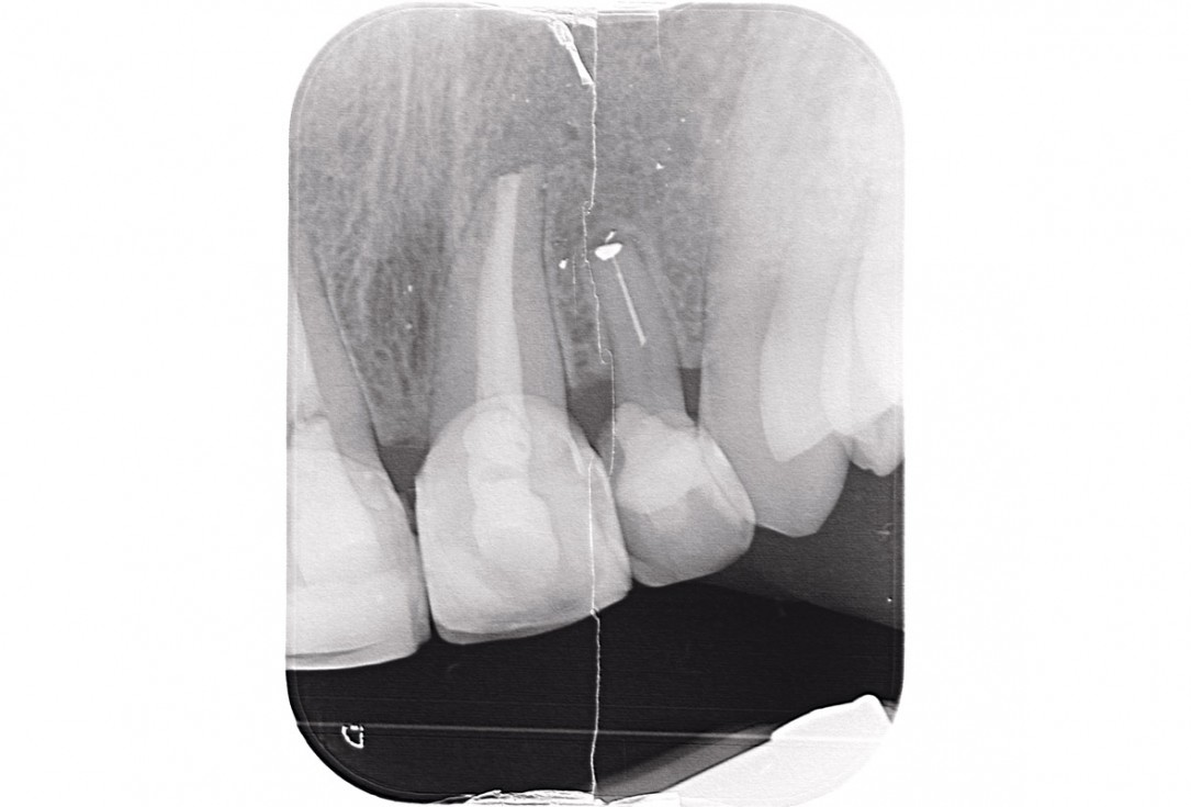 Delayed implant placement and horizontal GBR using cerabone® and Jason® membrane - Dr. S. Pelekanos