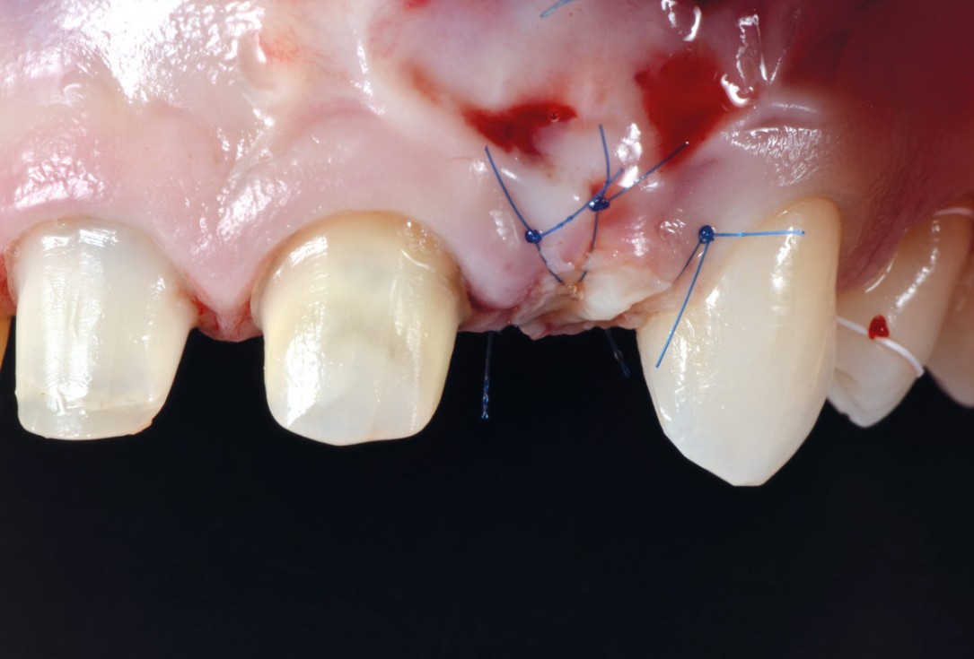 Delayed implant placement and horizontal GBR using cerabone® and Jason® membrane - Dr. S. Pelekanos