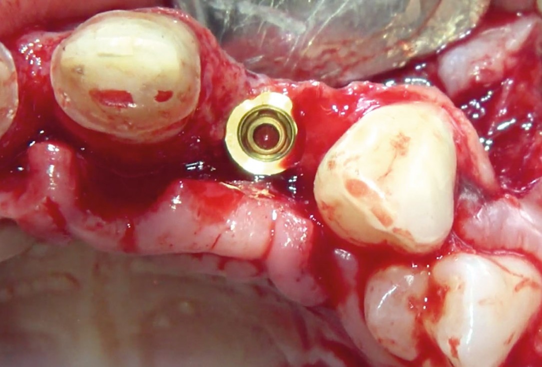 Delayed implant placement and horizontal GBR using cerabone® and Jason® membrane - Dr. S. Pelekanos