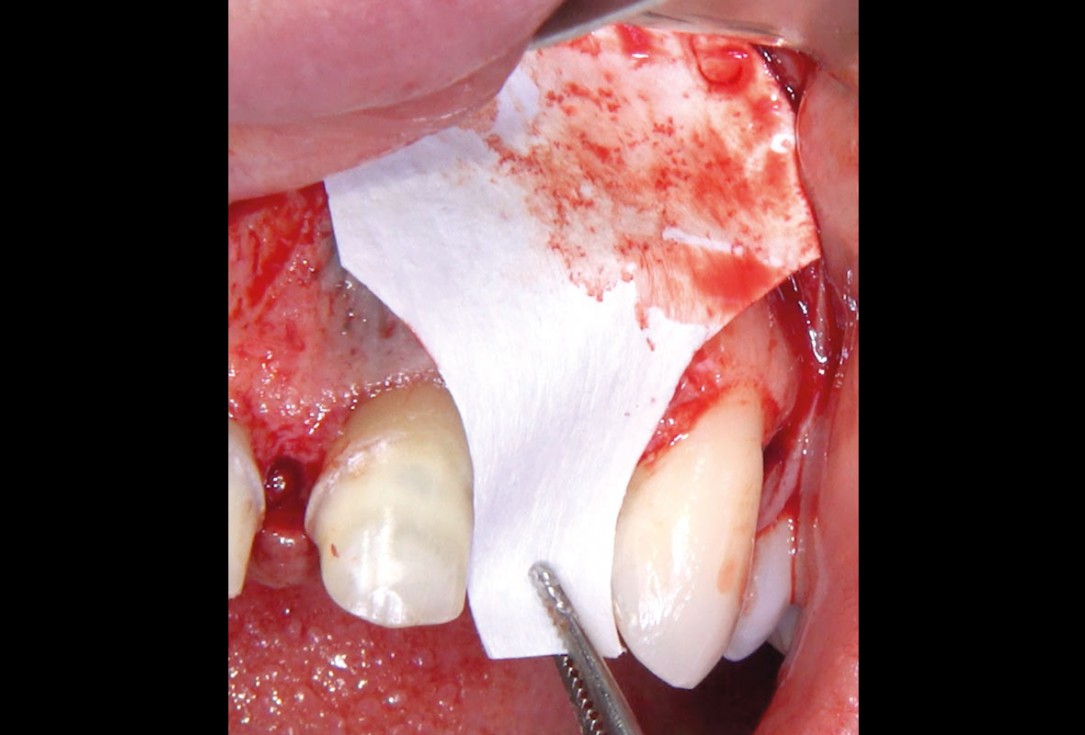 Delayed implant placement and horizontal GBR using cerabone® and Jason® membrane - Dr. S. Pelekanos