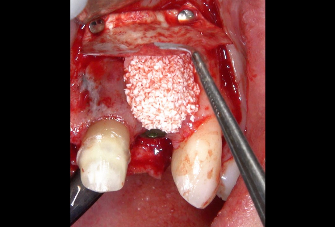 Delayed implant placement and horizontal GBR using cerabone® and Jason® membrane - Dr. S. Pelekanos