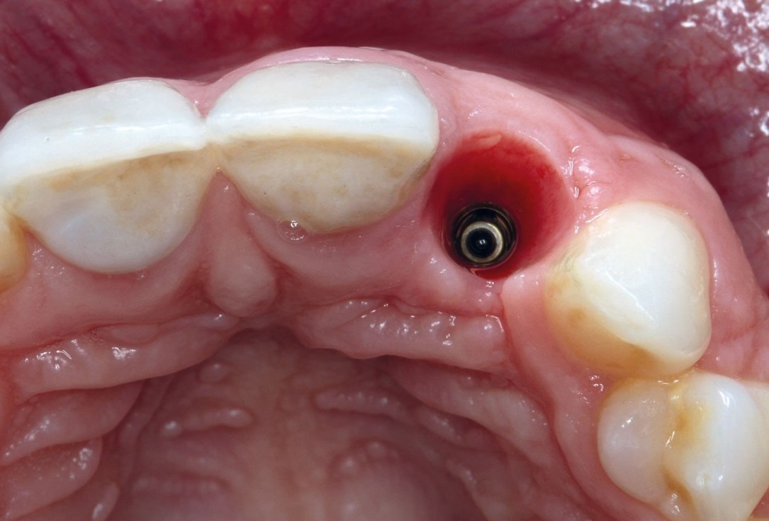 Delayed implant placement and horizontal GBR using cerabone® and Jason® membrane - Dr. S. Pelekanos
