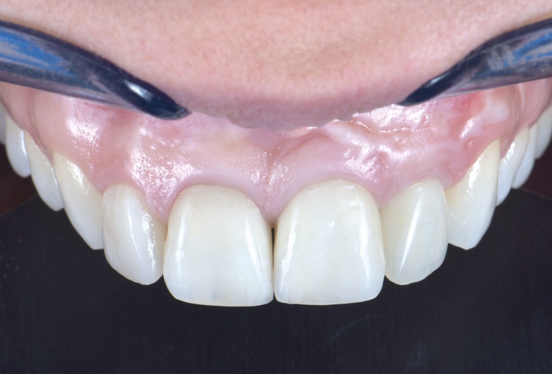 Delayed implant placement and horizontal GBR using cerabone® and Jason® membrane - Dr. S. Pelekanos