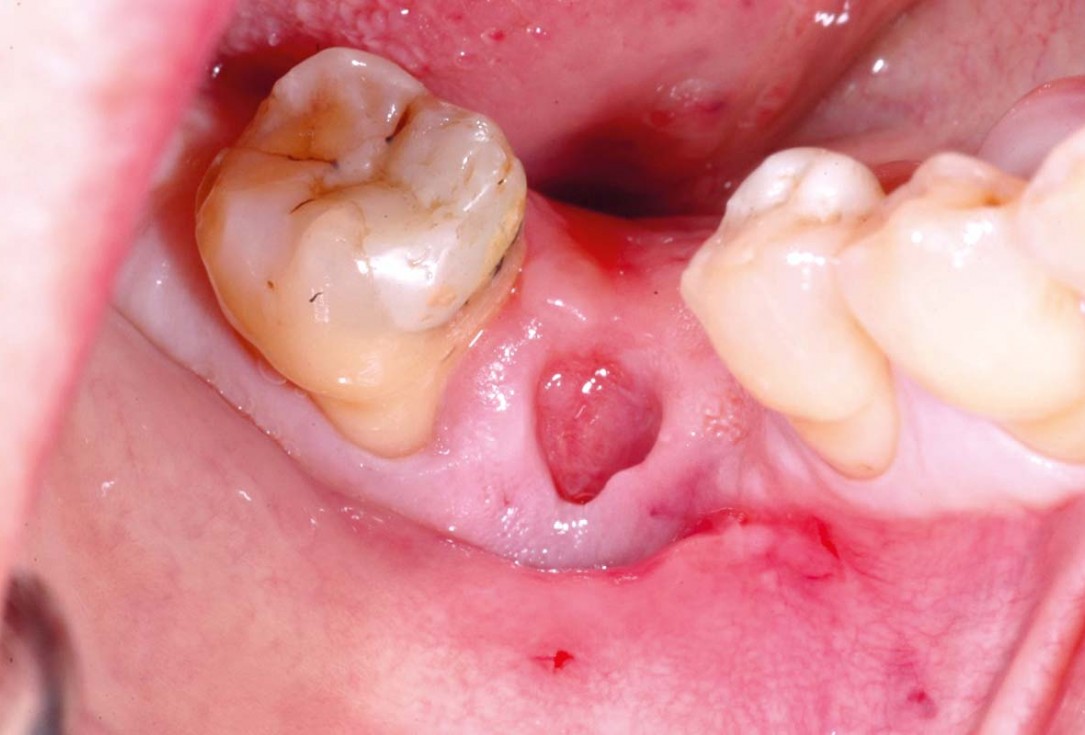 Bone defect augmentation in the lower jaw using autologous bone, cerabone® and permamem® - Dr. A. Caiazzo