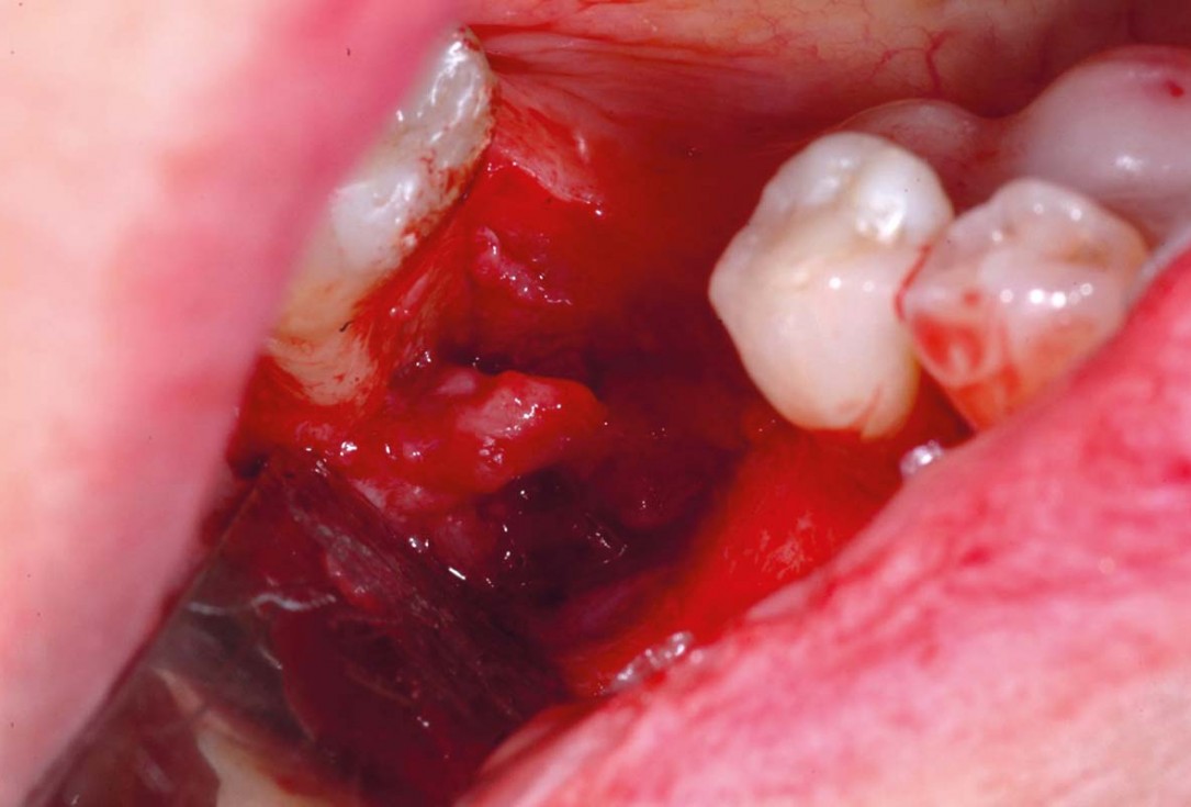 Bone defect augmentation in the lower jaw using autologous bone, cerabone® and permamem® - Dr. A. Caiazzo