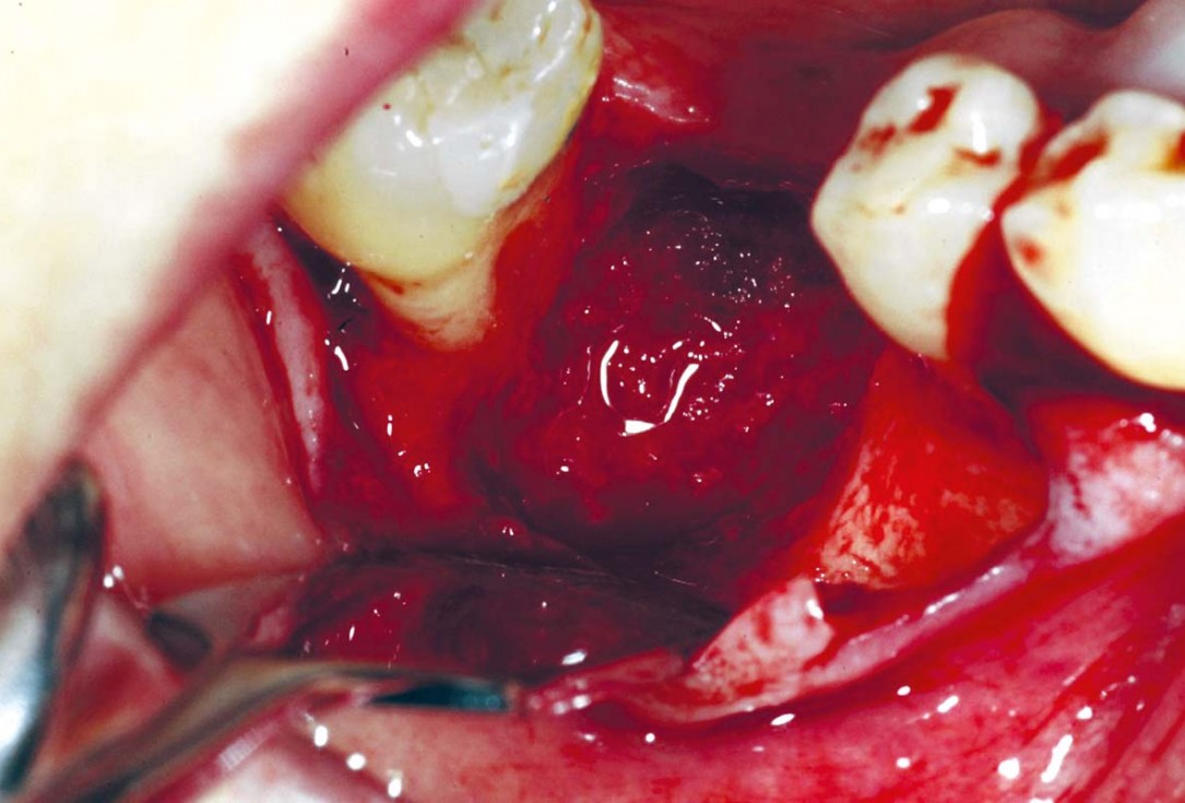 Bone defect augmentation in the lower jaw using autologous bone, cerabone® and permamem® - Dr. A. Caiazzo