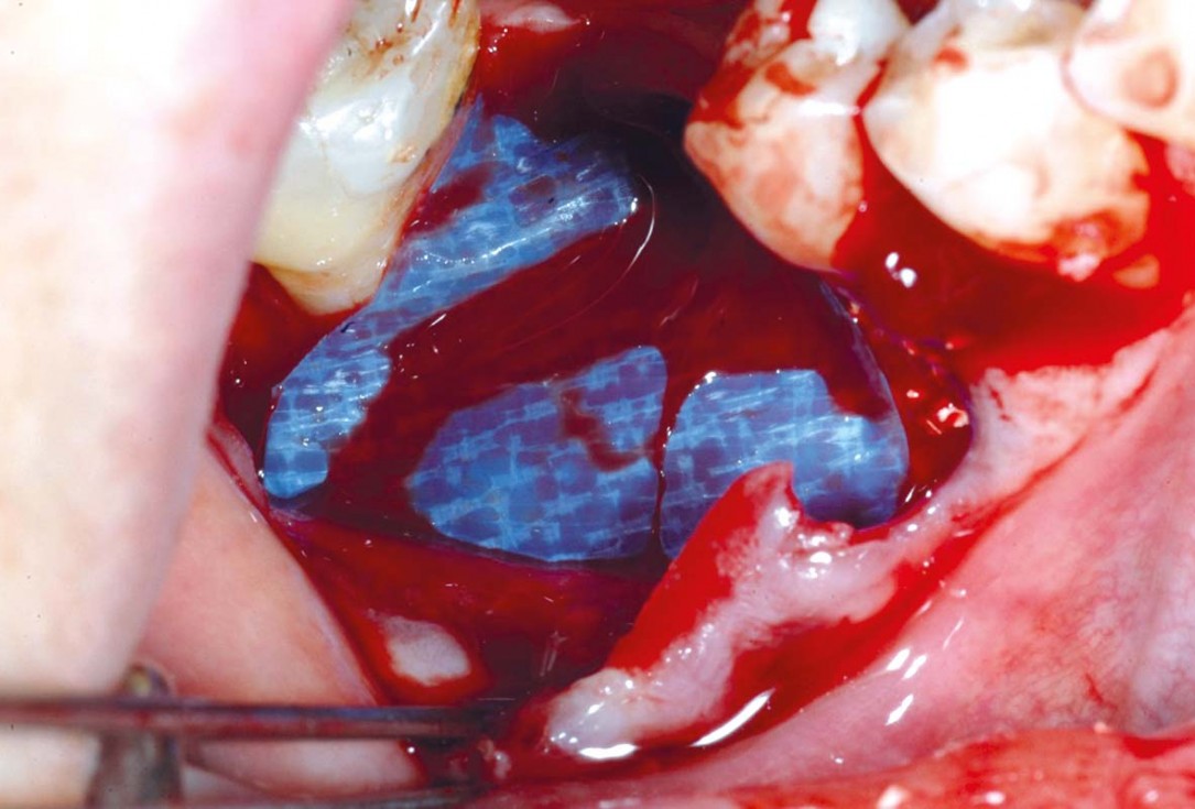 Bone defect augmentation in the lower jaw using autologous bone, cerabone® and permamem® - Dr. A. Caiazzo