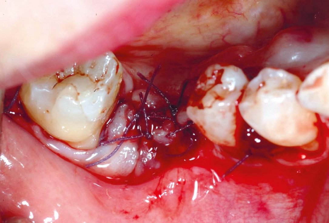 Bone defect augmentation in the lower jaw using autologous bone, cerabone® and permamem® - Dr. A. Caiazzo