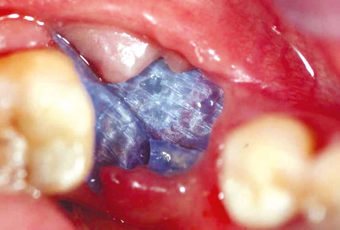 Bone defect augmentation in the lower jaw using autologous bone, cerabone® and permamem® - Dr. A. Caiazzo