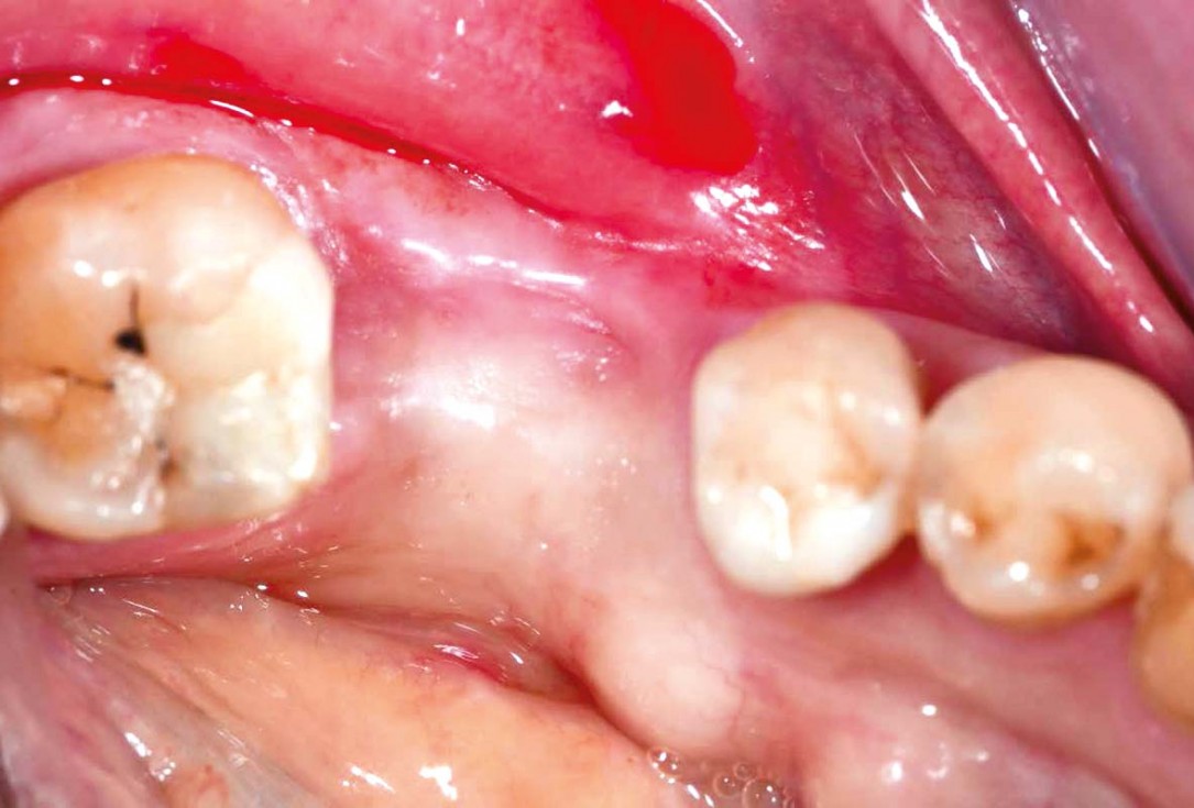 Bone defect augmentation in the lower jaw using autologous bone, cerabone® and permamem® - Dr. A. Caiazzo