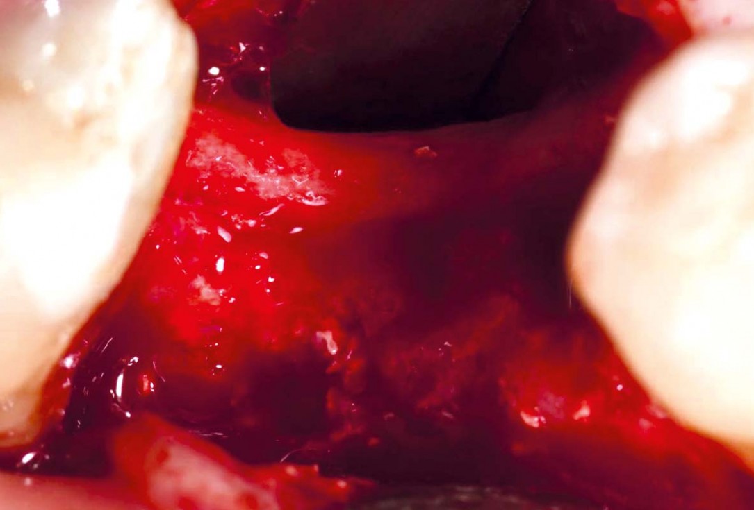 Bone defect augmentation in the lower jaw using autologous bone, cerabone® and permamem® - Dr. A. Caiazzo