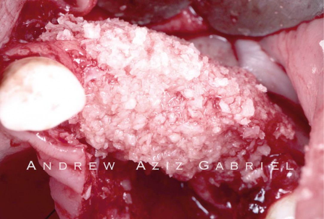 Horizontal/vertical GBR using cerabone®/maxgraft®, Jason® membrane/collprotect® membrane and Ti-mesh - Dr. A. Aziz 