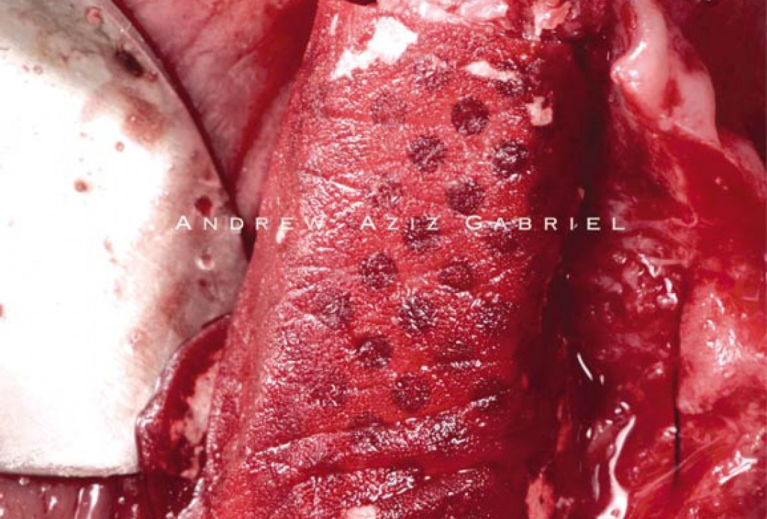 Horizontal/vertical GBR using cerabone®/maxgraft®, Jason® membrane/collprotect® membrane and Ti-mesh - Dr. A. Aziz 