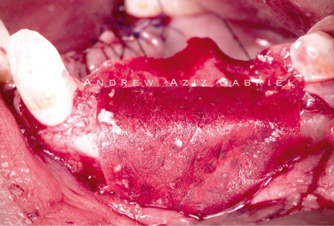 Horizontal/vertical GBR using cerabone®/maxgraft®, Jason® membrane/collprotect® membrane and Ti-mesh - Dr. A. Aziz 