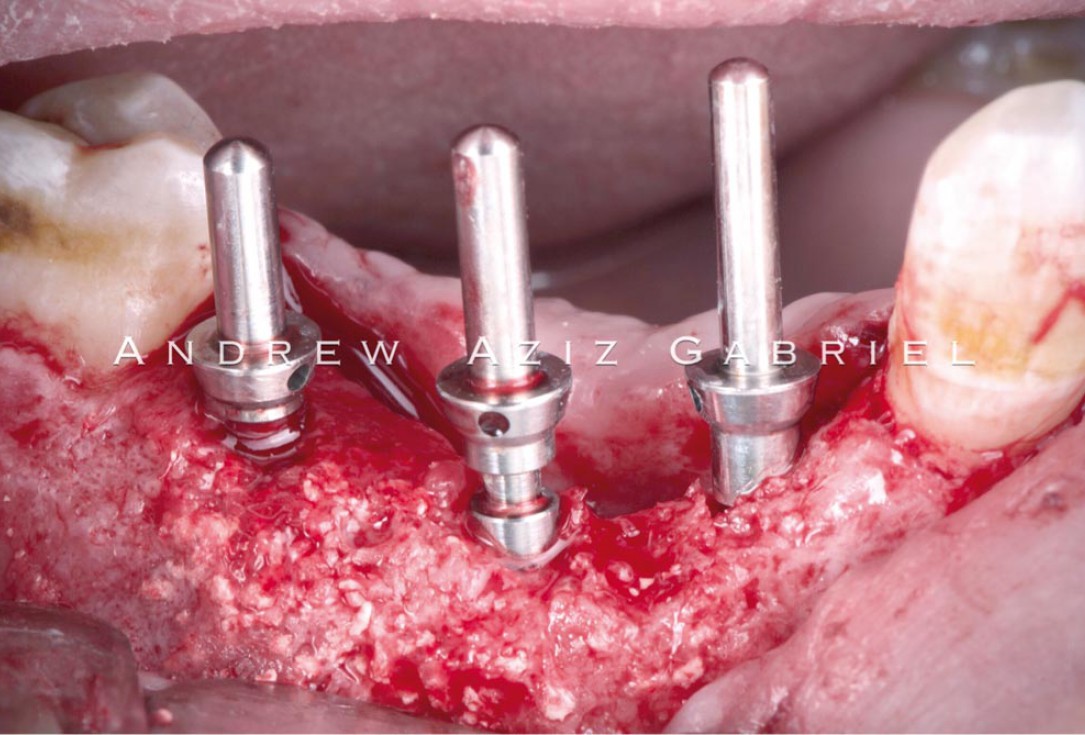 Horizontal/vertical GBR using cerabone®/maxgraft®, Jason® membrane/collprotect® membrane and Ti-mesh - Dr. A. Aziz 