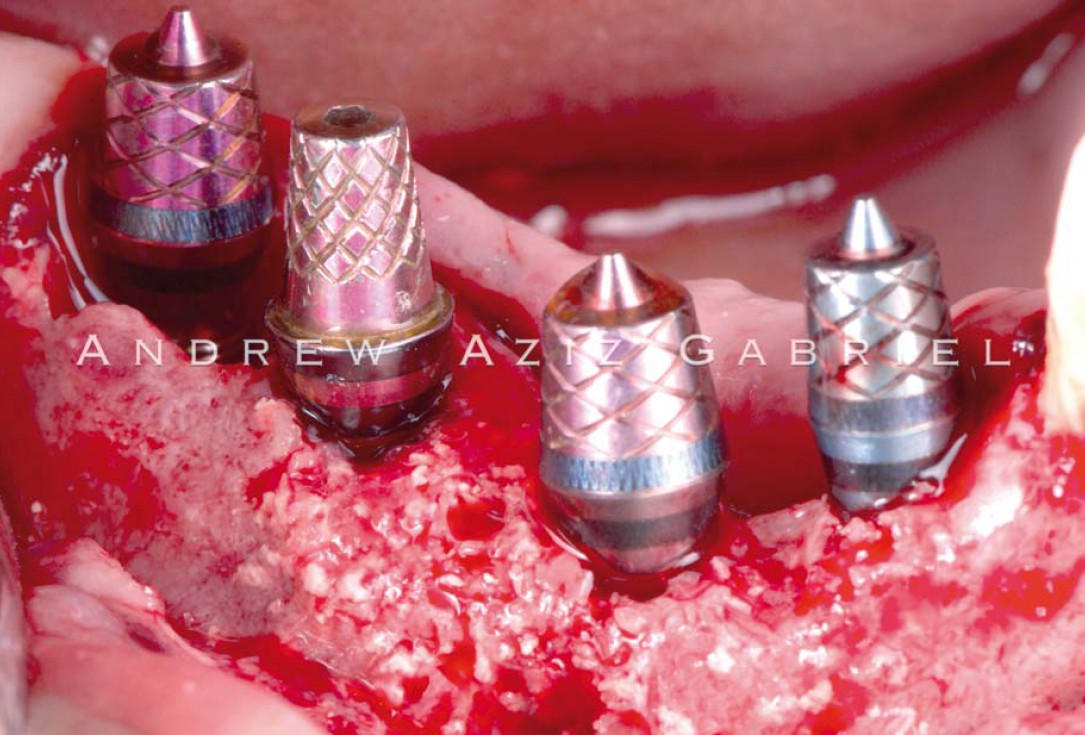 Horizontal/vertical GBR using cerabone®/maxgraft®, Jason® membrane/collprotect® membrane and Ti-mesh - Dr. A. Aziz 