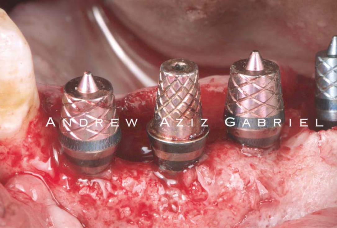 Horizontal/vertical GBR using cerabone®/maxgraft®, Jason® membrane/collprotect® membrane and Ti-mesh - Dr. A. Aziz 