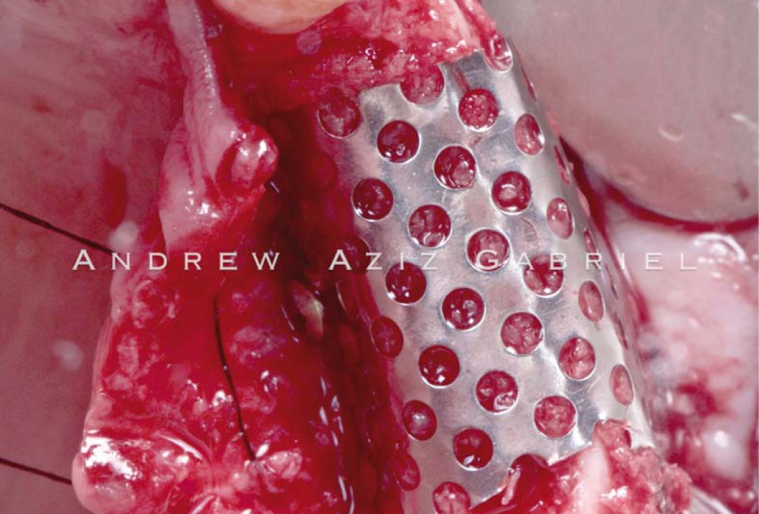 Horizontal/vertical GBR using cerabone®/maxgraft®, Jason® membrane/collprotect® membrane and Ti-mesh - Dr. A. Aziz 