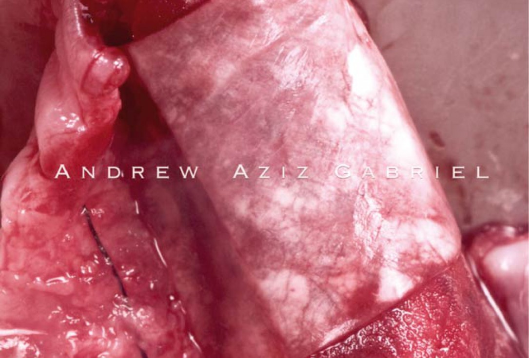 Horizontal/vertical GBR using cerabone®/maxgraft®, Jason® membrane/collprotect® membrane and Ti-mesh - Dr. A. Aziz 