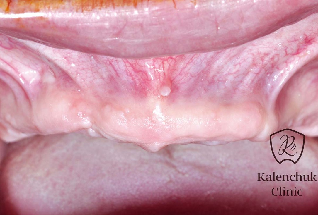 GBR of the edentulous maxillary ridge using permamem®, cerabone® and autologous bone chips - Dr. V. Kalenchuk