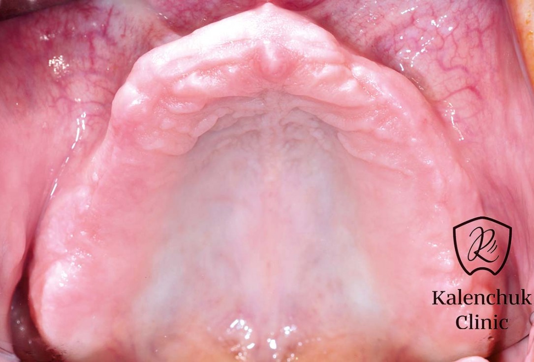 GBR of the edentulous maxillary ridge using permamem®, cerabone® and autologous bone chips - Dr. V. Kalenchuk