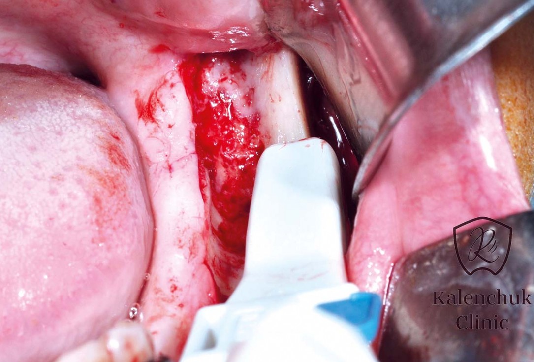 GBR of the edentulous maxillary ridge using permamem®, cerabone® and autologous bone chips - Dr. V. Kalenchuk