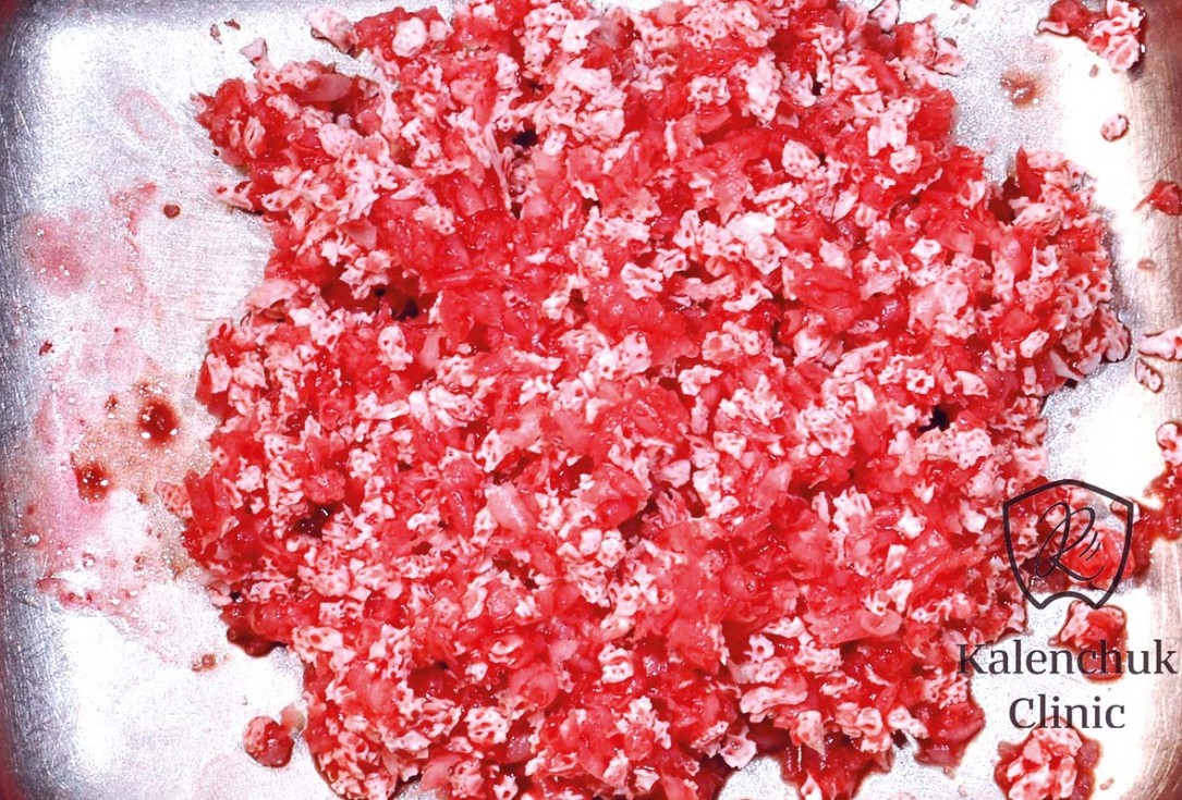 GBR of the edentulous maxillary ridge using permamem®, cerabone® and autologous bone chips - Dr. V. Kalenchuk