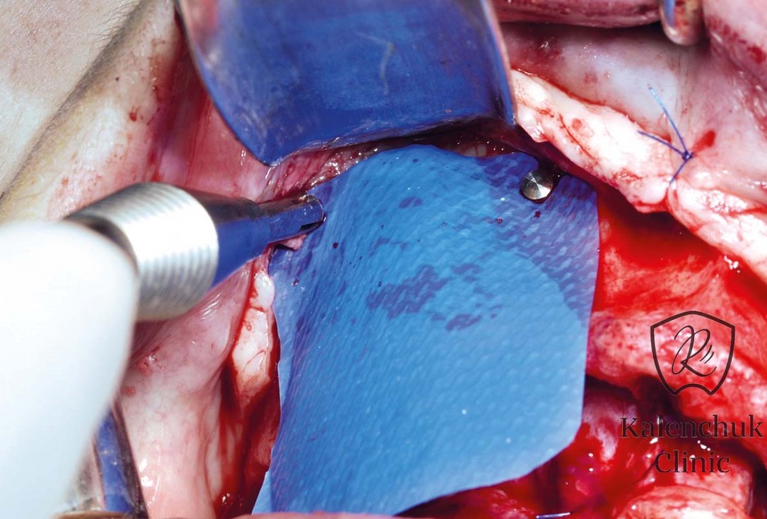 GBR of the edentulous maxillary ridge using permamem®, cerabone® and autologous bone chips - Dr. V. Kalenchuk