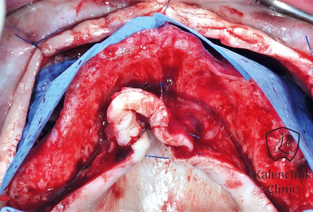 GBR of the edentulous maxillary ridge using permamem®, cerabone® and autologous bone chips - Dr. V. Kalenchuk