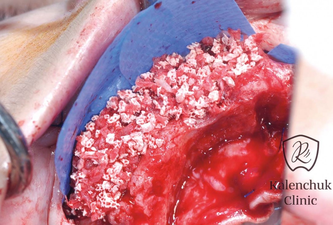 GBR of the edentulous maxillary ridge using permamem®, cerabone® and autologous bone chips - Dr. V. Kalenchuk