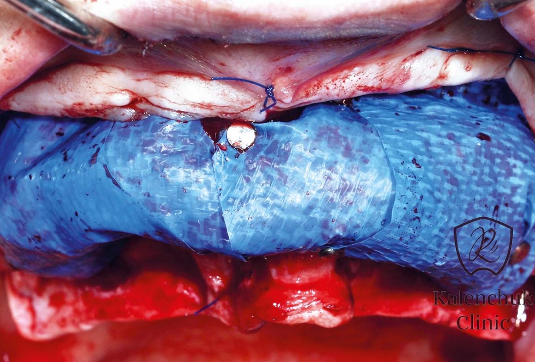 GBR of the edentulous maxillary ridge using permamem®, cerabone® and autologous bone chips - Dr. V. Kalenchuk