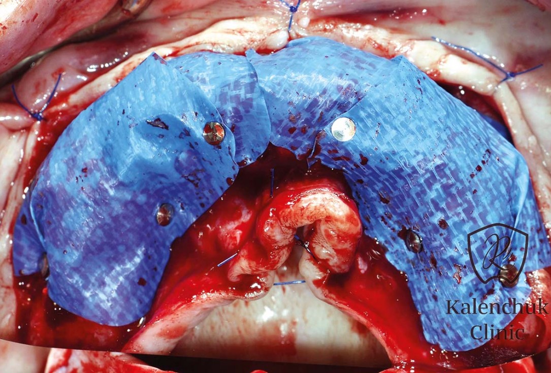 GBR of the edentulous maxillary ridge using permamem®, cerabone® and autologous bone chips - Dr. V. Kalenchuk