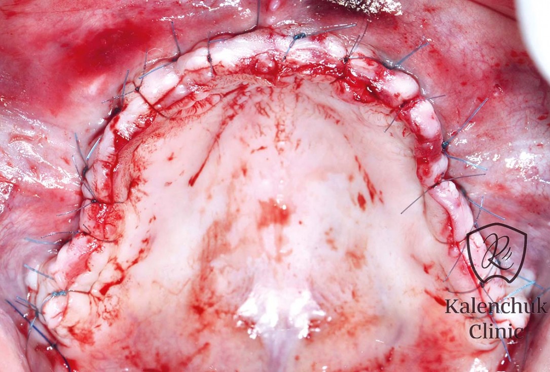 GBR of the edentulous maxillary ridge using permamem®, cerabone® and autologous bone chips - Dr. V. Kalenchuk