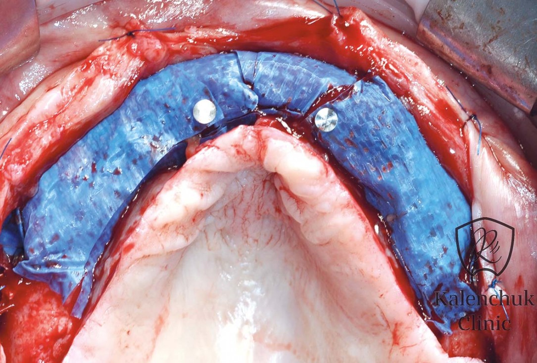 GBR of the edentulous maxillary ridge using permamem®, cerabone® and autologous bone chips - Dr. V. Kalenchuk