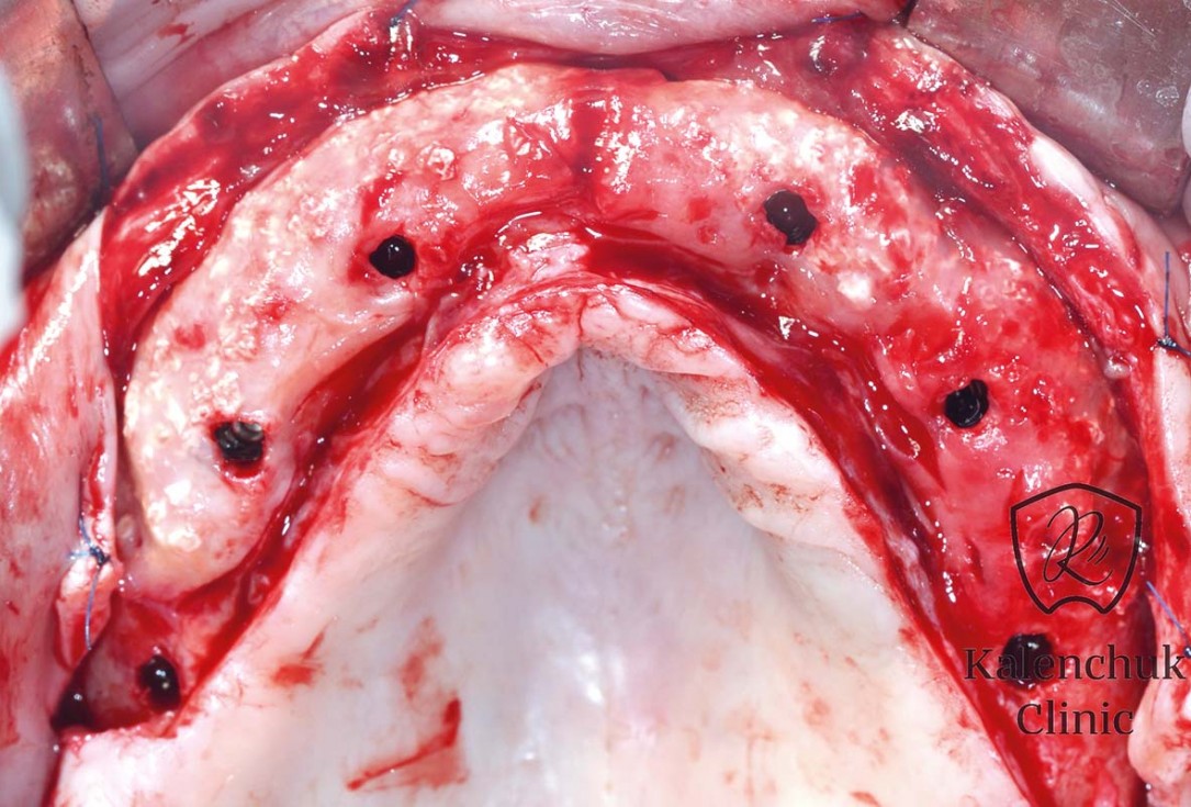 GBR of the edentulous maxillary ridge using permamem®, cerabone® and autologous bone chips - Dr. V. Kalenchuk