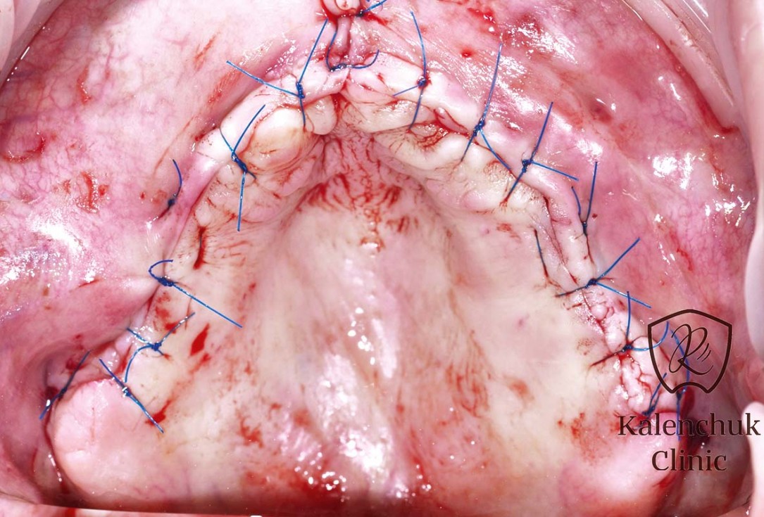 GBR of the edentulous maxillary ridge using permamem®, cerabone® and autologous bone chips - Dr. V. Kalenchuk