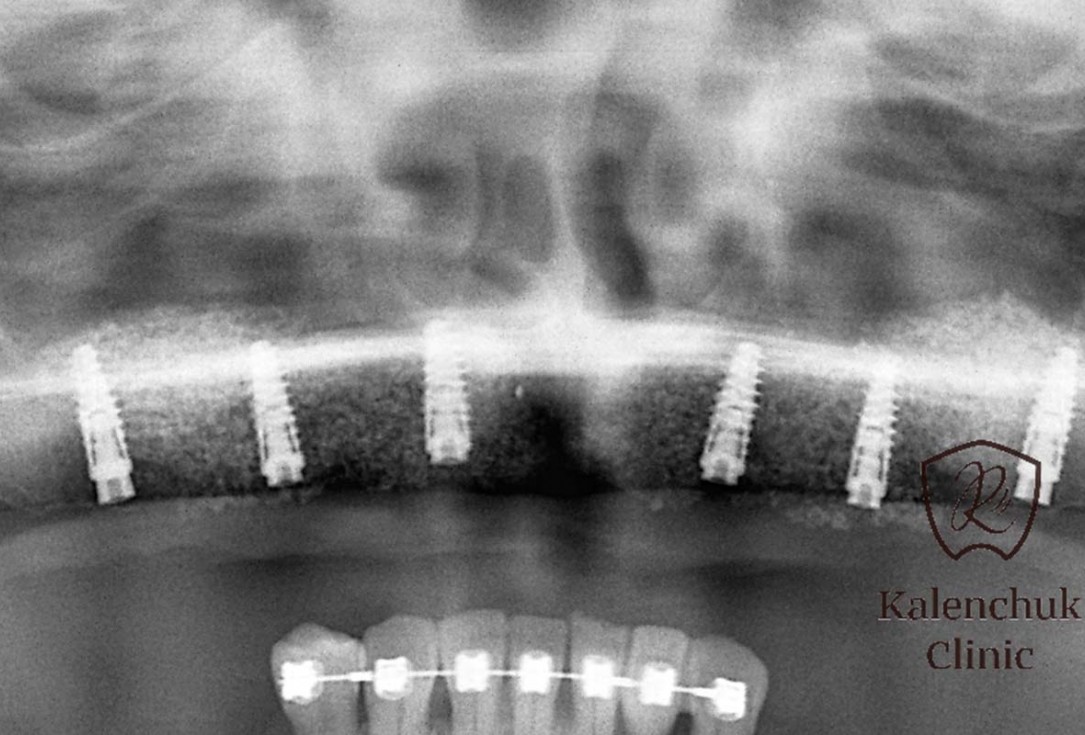 GBR of the edentulous maxillary ridge using permamem®, cerabone® and autologous bone chips - Dr. V. Kalenchuk