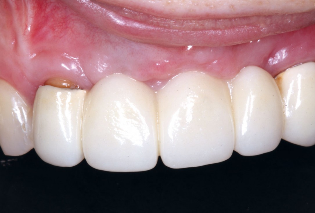 botiss-cerabone-permamem-maxgraft-mucoderm-horizontal-gbr-maghaireh
