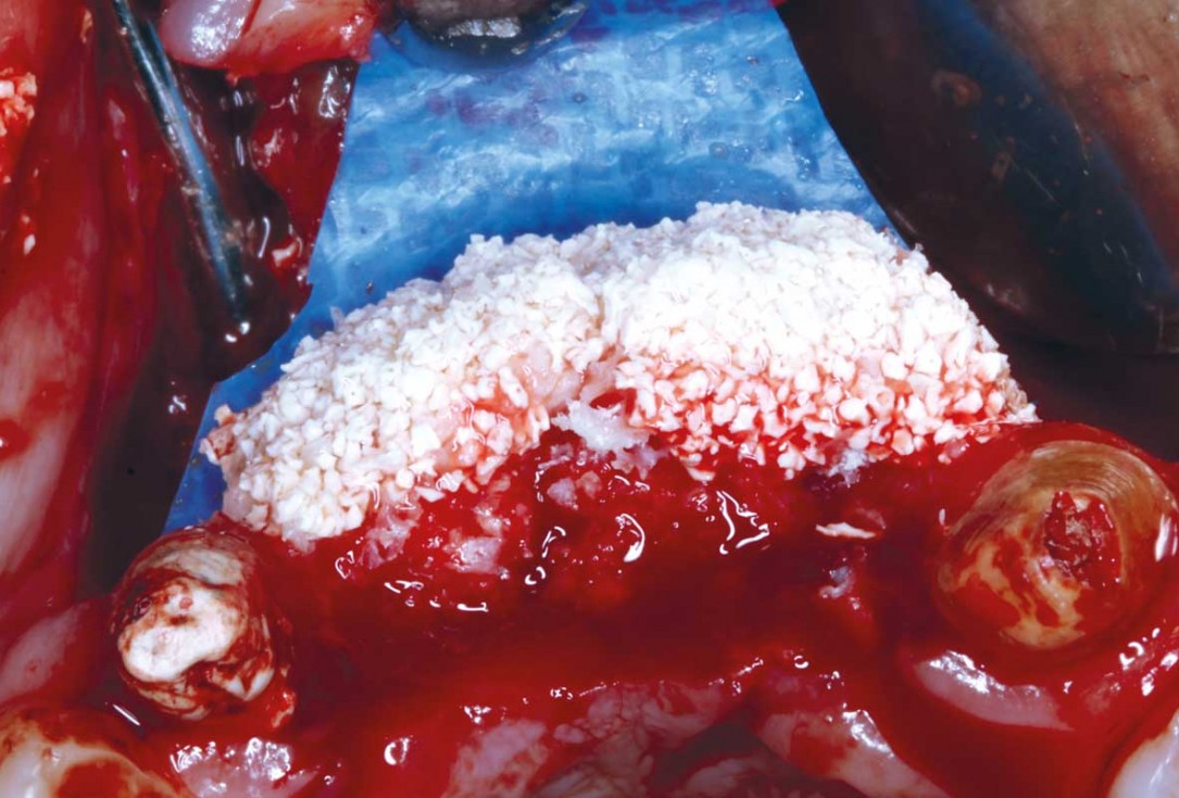 botiss-cerabone-permamem-maxgraft-mucoderm-horizontal-gbr-maghaireh