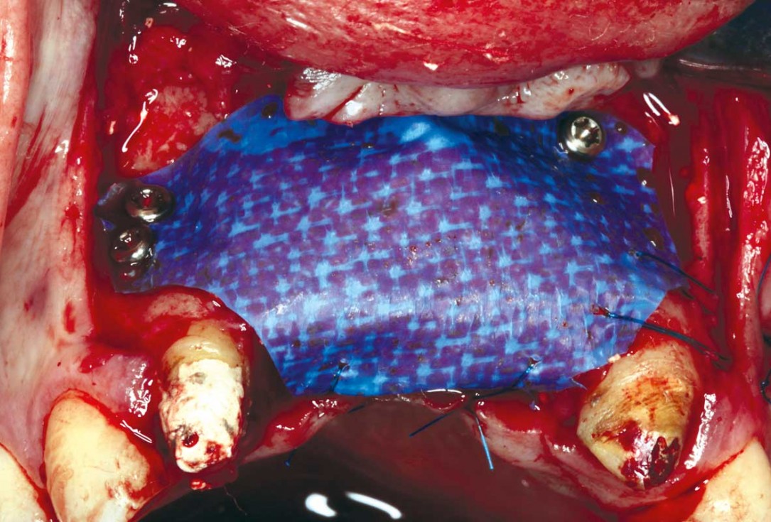 botiss-cerabone-permamem-maxgraft-mucoderm-horizontal-gbr-maghaireh