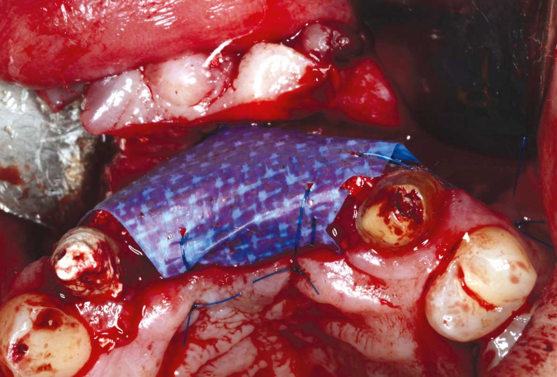 botiss-cerabone-permamem-maxgraft-mucoderm-horizontal-gbr-maghaireh