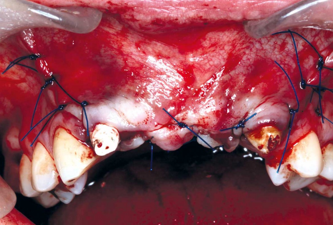 botiss-cerabone-permamem-maxgraft-mucoderm-horizontal-gbr-maghaireh