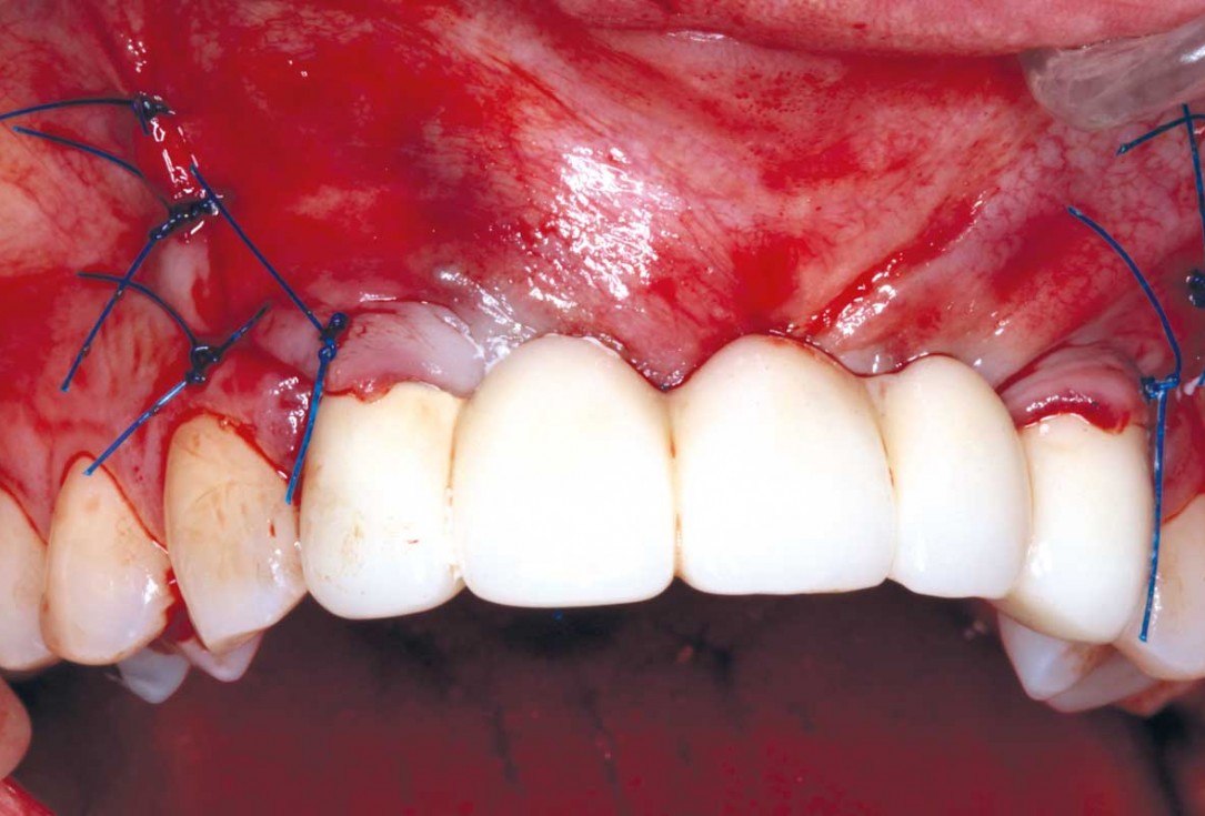 botiss-cerabone-permamem-maxgraft-mucoderm-horizontal-gbr-maghaireh