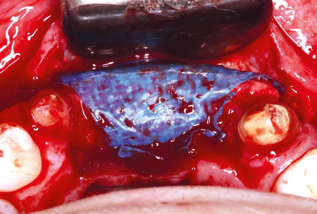 botiss-cerabone-permamem-maxgraft-mucoderm-horizontal-gbr-maghaireh